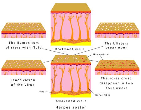 Shingles Virus Diagram